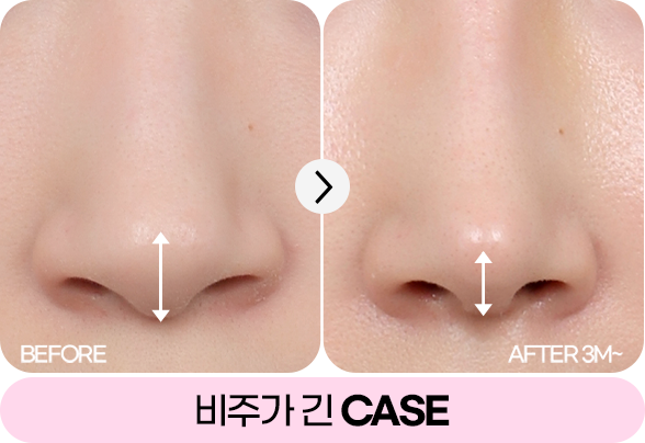 디에이 자가늑 코성형