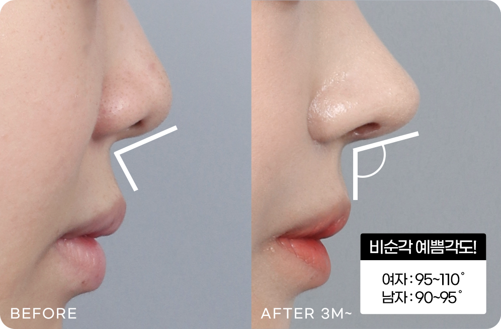 디에이 각도 코성형