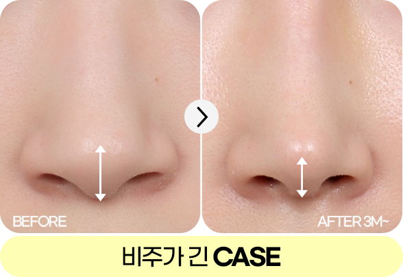 디에이 각도 코성형