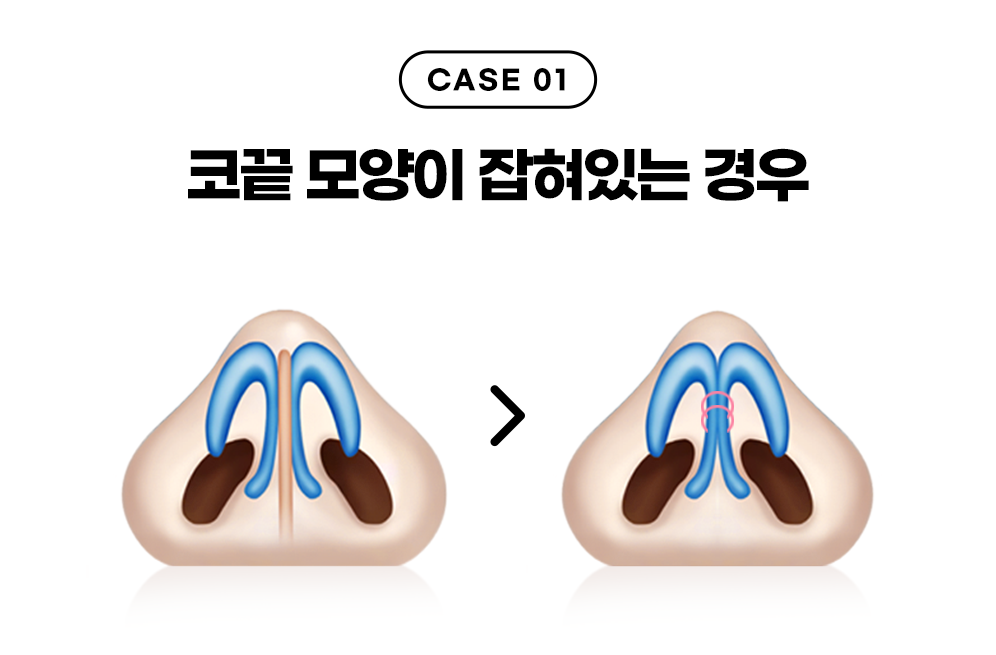 디에이 코끝성형