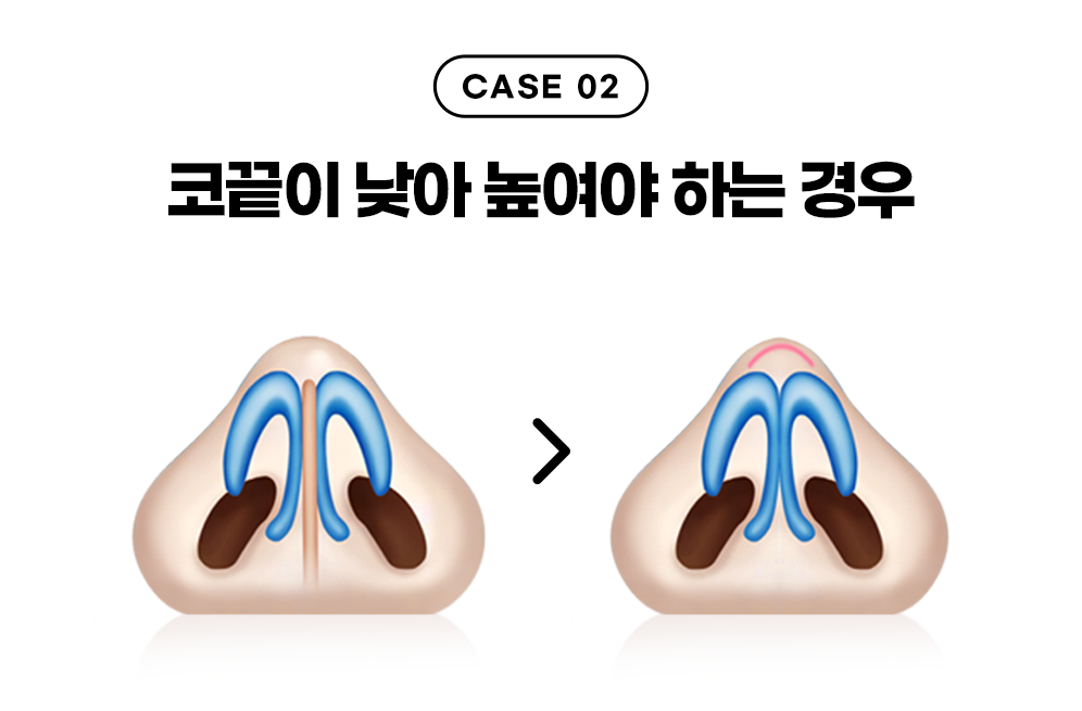 디에이 코끝성형