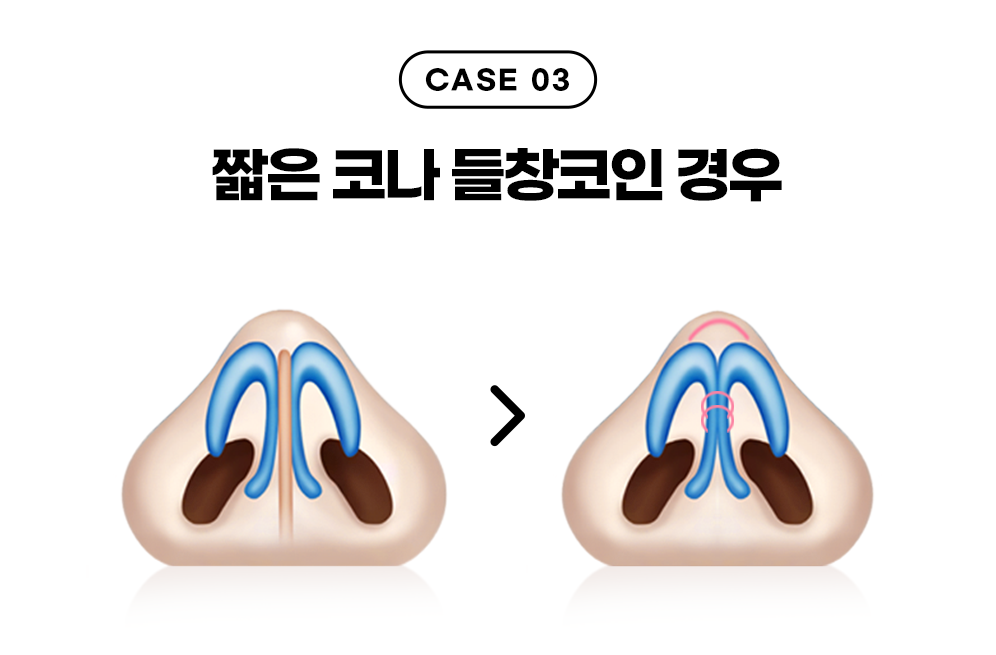 디에이 코끝성형