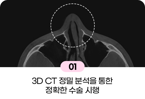 디에이 코끝성형
