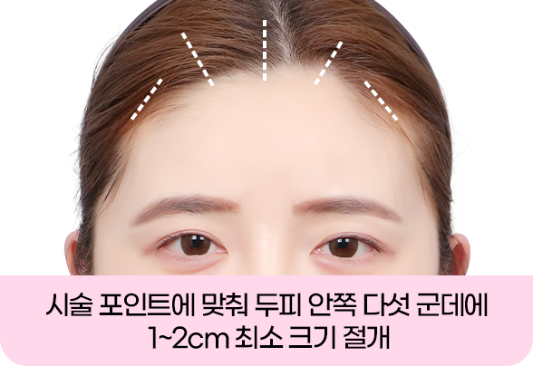 디에이 올아이 리프팅