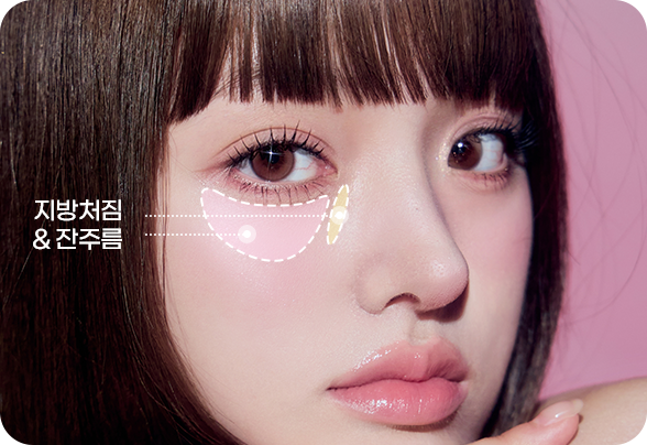 디에이 눈밑 지방재배치