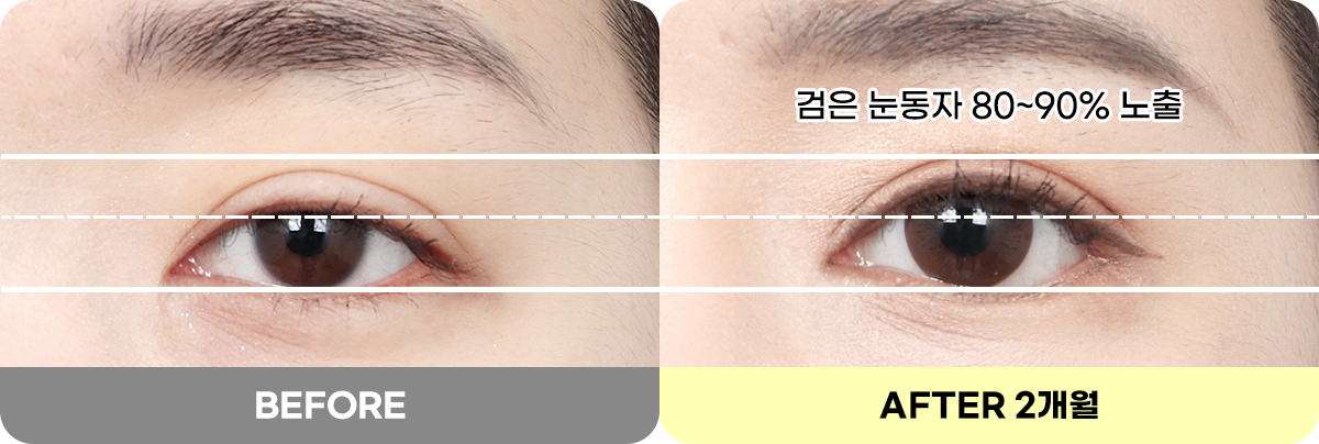 디에이 눈매 교정