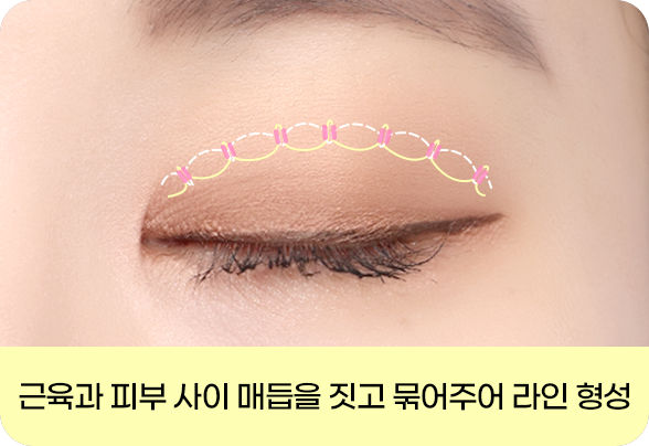 디에이 눈매 교정