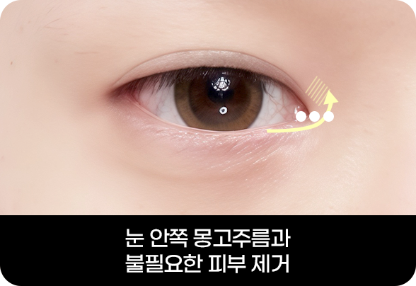 디에이 눈매확장트임