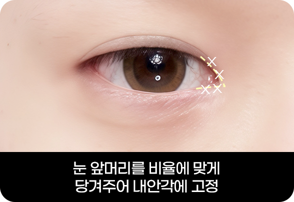 디에이 눈매확장트임