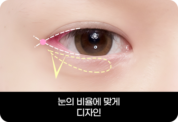 디에이 눈매확장트임