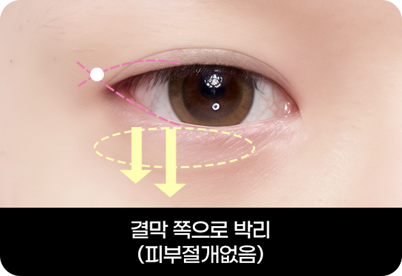 디에이 눈매확장트임