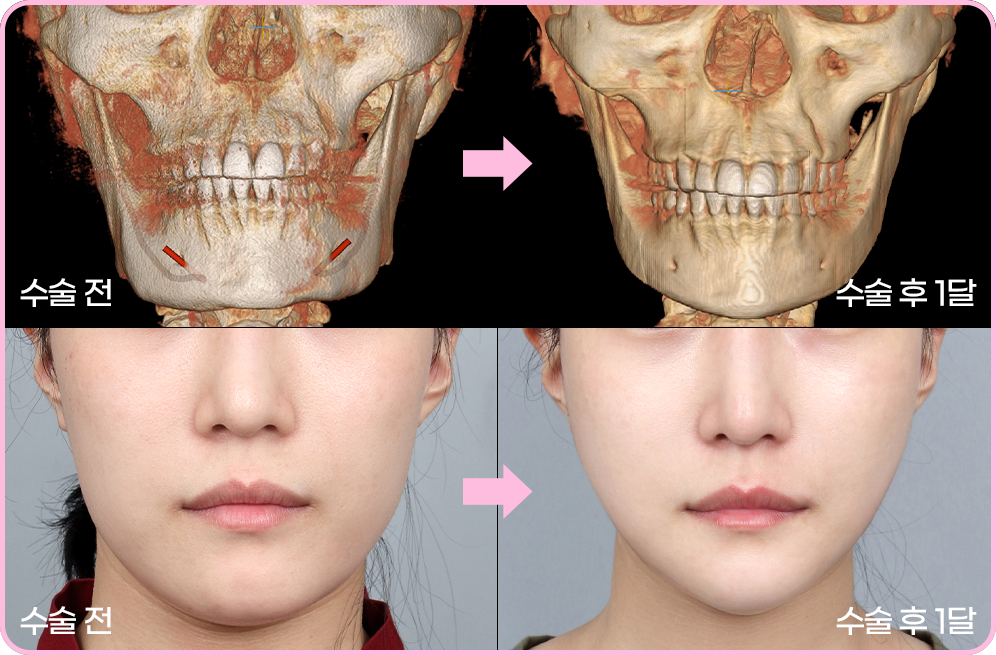 디에이 노핀윤곽