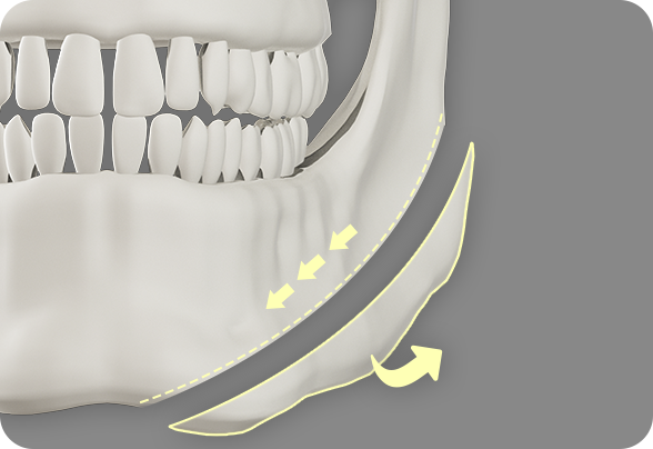 디에이 사각턱수술