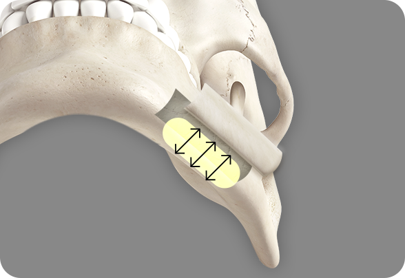 디에이 사각턱수술