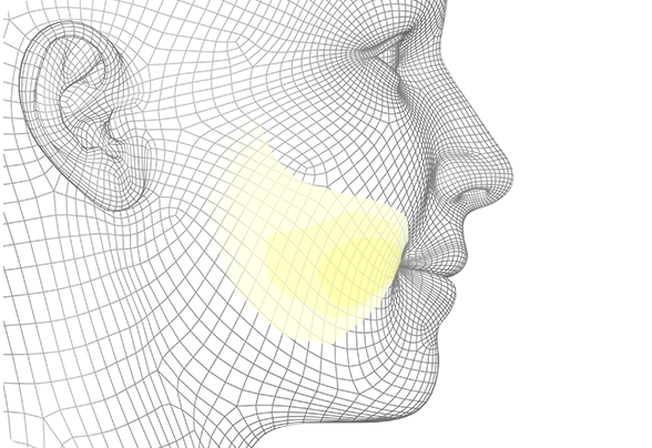 디에이 사각턱수술