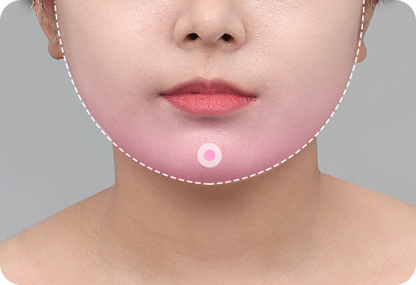 안면윤곽 긴곡선 사각턱수술 및 턱끝 성형 시행