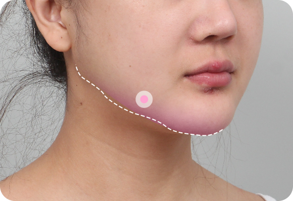 안면윤곽 재수술 계단현상, 이차각 매끈한 개선