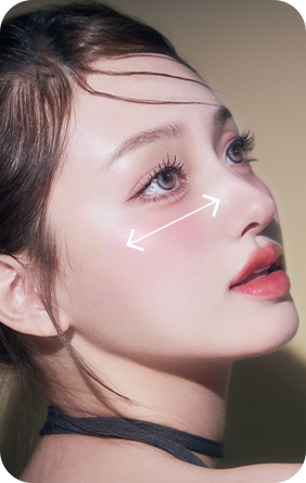 턱 끝 돌출 정도에 따른 안면윤곽 재수술