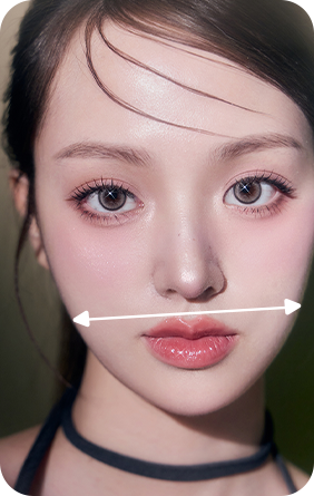 작은턱 안면윤곽 재수술