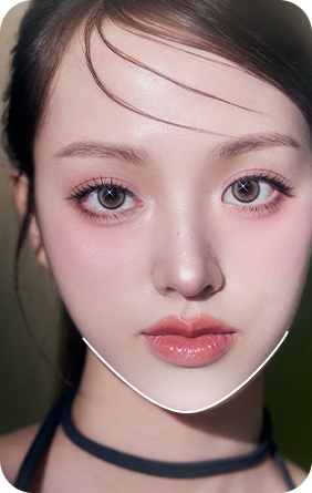 양각 너비 안면윤곽 재수술