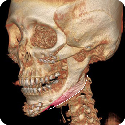 내 턱뼈에 딱 맞는 보형물로 재건