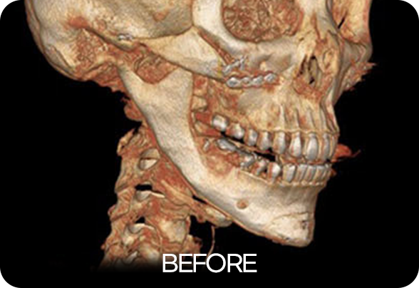 디에이 안면윤곽 재수술