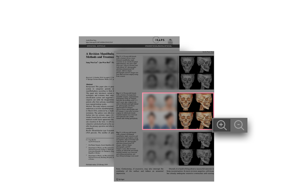 디에이 안면윤곽 재수술