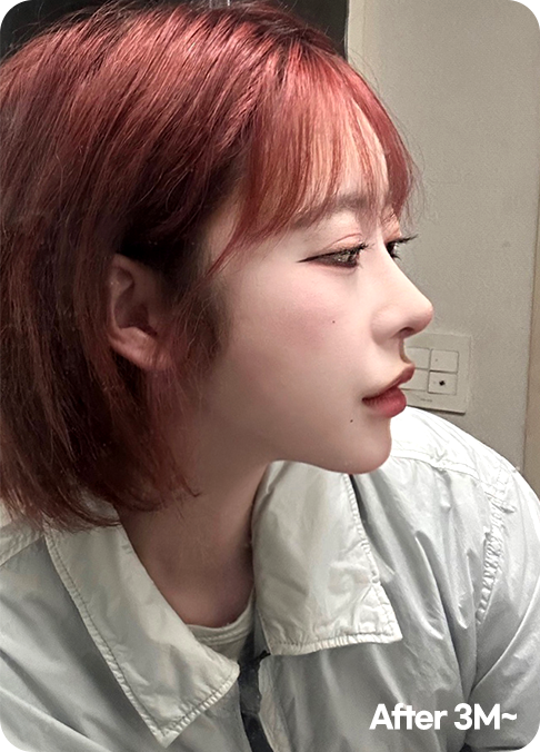 디에이 올아이 리프팅