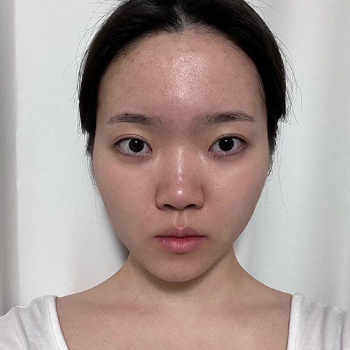 수술 전 (2)_500.jpg