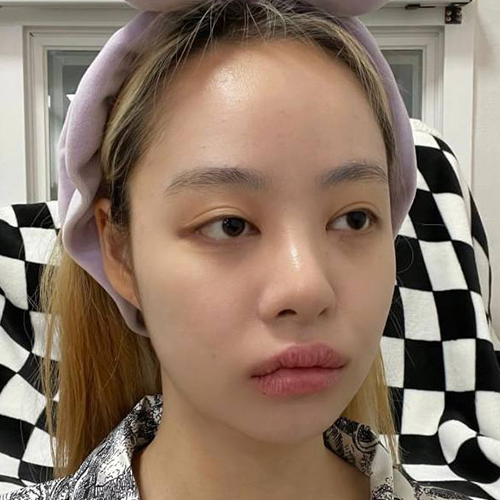 수술 전 (2)_500.jpg