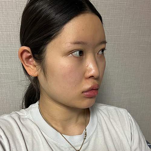 수술 전 (1)_500.jpg