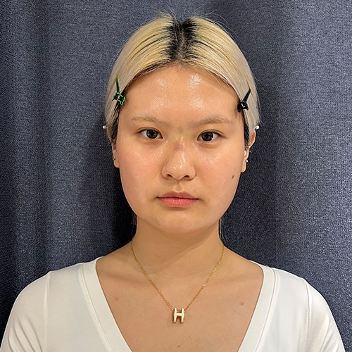 수술 전 (2)_500.jpg