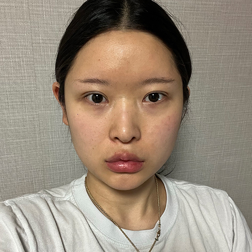 수술 전 (2)_500.jpg