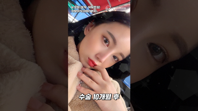 쌍수(절개)+뒤트임+밑트임 #Shorts