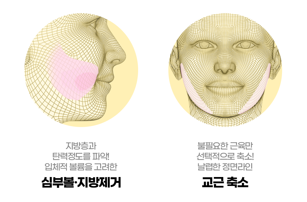 사각턱축소 이미지2