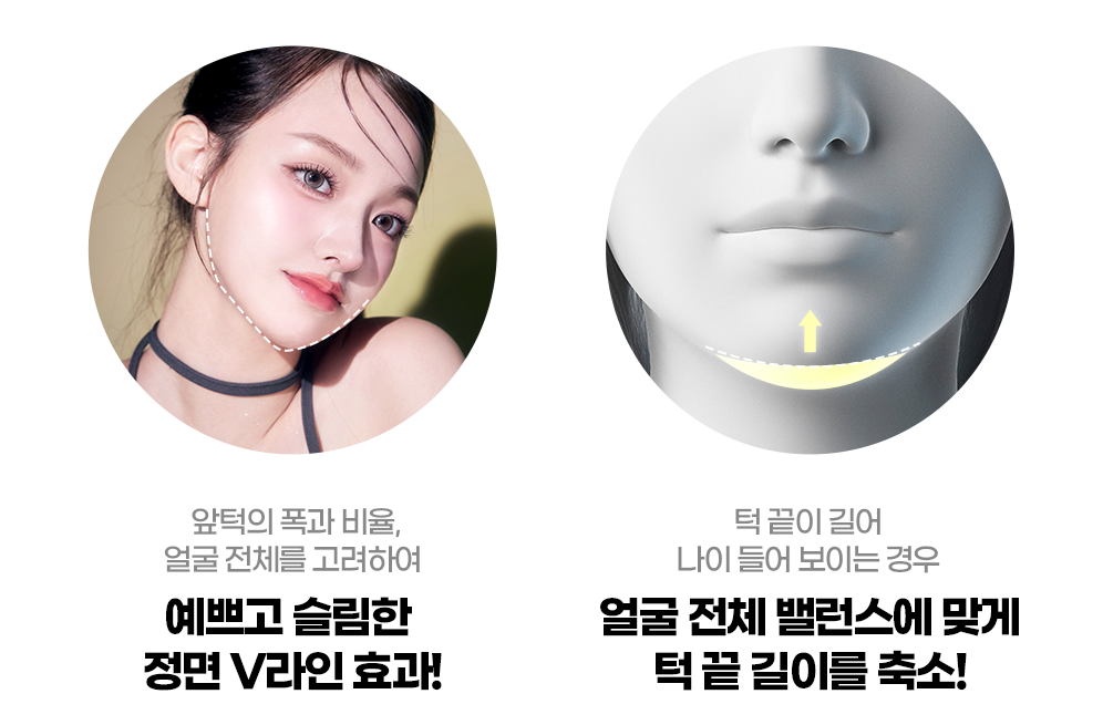 턱끝성형 효과1